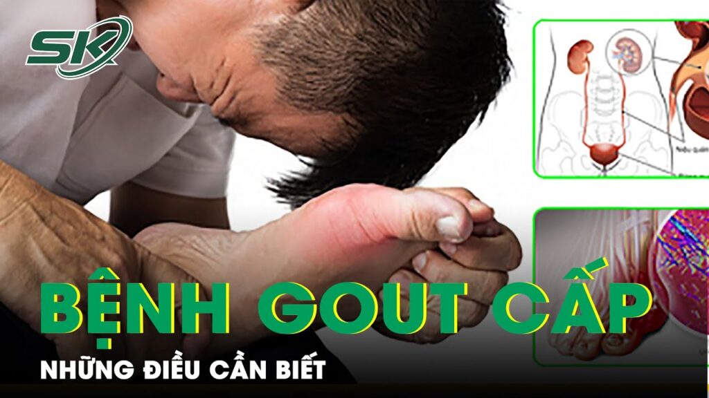 Những Điều Cần Biết Về Bệnh Gout Cấp | SKĐS