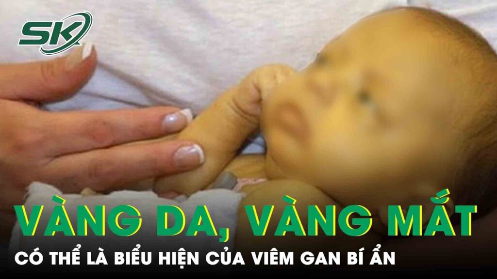 Cảnh Giác Với Chứng Vàng Da, Vàng Mắt: Có Thể Là Biểu Hiện Của Viêm Gan Bí Ẩn | SKĐS